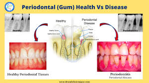 The longer plaque and tartar are on teeth, the more harmful they become. Periodontitis Gingivitis Meaning Symptoms Tx Gum Disease