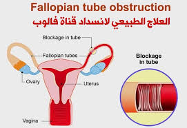 Its usual onset occurs around the time that menstruation begins. ØªÙ…ÙˆÙŠÙ‡ Ø¨Ù„Ù…ÙŠÙ„ Ø®Ø§Ù… Ø§Ù„ØºØ³ÙŠÙ„ Ø§Ù„Ø§Ù†Ø¨ÙˆØ¨Ù‰ Ù„Ù„Ø±Ø­Ù… Sunteckgilberthill Com