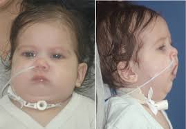 Image result for Micrognathia