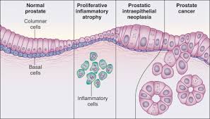 But most prostate cancers grow slowly and don't cause any health problems. Prostate Cancer Sciencedirect