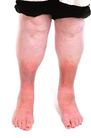 Differentiating Between Red Legs And Cellulitis