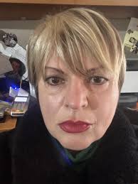 Men's hair loss in the cast of "Hair"