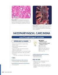 Study flashcards on usmle step 1: Nasopharyngeal Carcinoma Osmosis