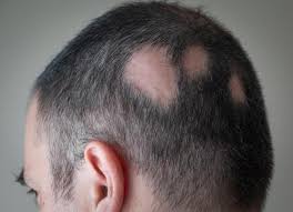 N'oubliez pas de partager cet article. 6 Maladies Qui Font Perdre Les Cheveux