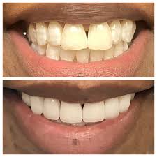 Desoto Cosmetic Dentist At Amaze Dental 972 230 1100 Cosmetic Dentist Dental Dentist
