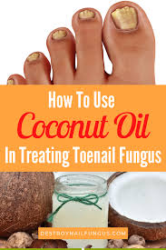 use coconut oil for toenail fungus