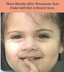 Amazon.com : XScar Kids Silicone Scar Treatment with Vit C/E