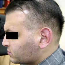 Paciente aos 22 dias de vida. Encefalocele parieto-occipital.