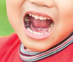 Stainless Steel Crowns For Kids