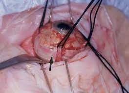 This is a very serious condition that your ophthalmologist must treat quickly to prevent blindness. Retinal Detachment Imaging Of Surgical Treatments And Complications Radiographics