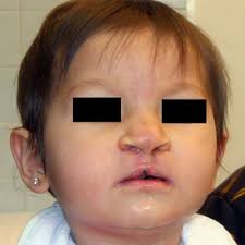 case 3): A 9 months female with CBCL with protruding premaxilla and...