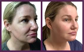 How much is a stair chair lift? The Hourlift Mini Facelifts Look 10 Years Younger Benefits And Costs