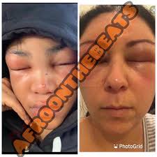 😱🙆🏾‍♂️Na allergy panel beat her, it wasn't me 🤫✊🏾 artiste @lhilfrosh  drops more evidence to support his case . He is saying she had an allergy  reaction Na why her face and