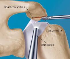 Arthroskopische Schultereingriffe Deutsches Schulterzentrum