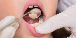 How Long Does A Tooth Extraction Hurt Tooth Extraction Aftercare