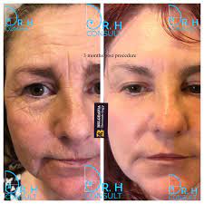 A complete range of supplements for before, during & after pregnancy What Is The Difference Between Ablative And Non Ablative Laser Resurfacing Dr H Consult