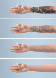 Picosure laser tattoo removal targets unwanted ink more effectively than previous technology. Laser Tattoo Removal Revivify Medical Spa Contact Us Today