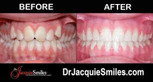 ¹ smilepay™ is $89/month for 24 months ($2,386 total) with a $250 deposit. Invisalign Vs Byte At Home Invisible Alignersdr Jacquie