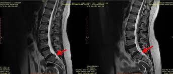 Durerea se manifestă la nivelul cervical, al. Cum Sa Tratam Hernia De Disc Fara Operatie Tion