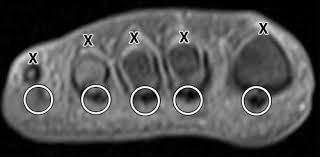 Learn about anatomy movement foot muscles with free interactive flashcards. Ct And Mr Imaging Of The Postoperative Ankle And Foot Radiographics