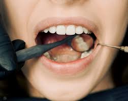 Image result for dental cancer
