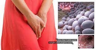 Ia boleh menyebabkan parutan pada rahim dan tiub falopia. Miss V Gatal Tak Semestinya Penyakit Kelamin Ia Mungkin Hanya Jangkitan Vagina Candidiasis Nona