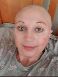 On a lighter note: At least I won't have much hair to loose!!😐😕😯😊