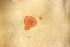 Ringworm, pictured here, is often circular. What 10 Common Skin Rashes Look Like