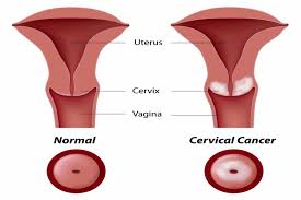 Precancerous conditions of the cervix include squamous intraepithelial lesions (sils). Cervical Cancer Treatment Treatment Cost Guide