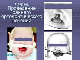 Hirurgicheskoe Lechenie I Reabilitaciya Detej S Vrozhdennymi Rasshelinami Guby I Neba