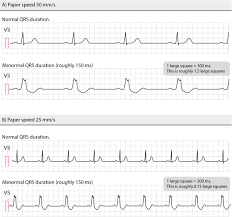 Ecg Interpretation Characteristics Of The Normal Ecg P