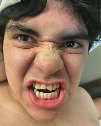 Nick broke some teeth playing basketball this weekend … by Sunday afternoon  he was put back together like nothing ever happened!! @dentalmedicgroup we  are so thankful and lucky to have such a