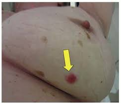 Our bodies change naturally over time. Management Of Local Regional Recurrences After Primary Breast Cancer Treatment Oncohema Key