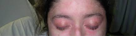 Image result for Dermatomyositis