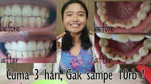 Namun, selain scaling gigi, ada cara alternatif lain yang bisa kamu lakukan untuk membersihkan karang gigi. Cara Menghilangkan Karang Gigi Dan Memutihkan Gigi Tidak Sampai 10k Mudah Dan Murah Youtube
