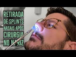 Infection can develop deep in the mucoperichondrial layer; Deviated Septum Surgery Septoplasty Youtube