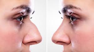 Se non riesci a trovarla, tocca prima mostra tutte le app o informazioni app. Rinofiller La Rinoplastica Non Chirurgica Senza Bisturi Per Un Naso Perfetto