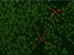 Image result for ANA Staining Pattern