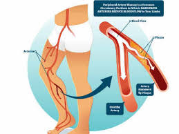 The symptoms of endocrine disorders vary significantly depending on what glands are affected. 2nd Breakthrough Device Designation Granted To Concept Medical Inc By Fda For Magictouch Pta Sirolimus Coated Balloon Times Of India