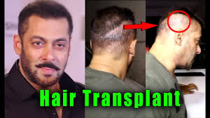 Bollywood 10 Actors Who Underwent For Hair Transplant Surgery Youtube hair transplant surgery