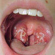 Whiteness in your throat can have several possible causes. What S Causing Those White Spots In Your Mouth And Throat Health24