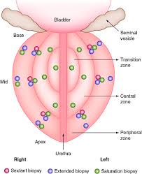Treatment for bladder cancer depends on your overall health, progression of the c. Prostate Needle Biopsy Sampling Techniques Impact On Pathological Diagnosis Springerlink