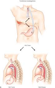 Following this, he completed his basic surgical training in dublin and was awarded a master of surgery (mch) degree from university college dublin in 2008. History Of Esophageal Surgery Springerlink