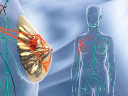 Was kann man tun, um diese nebenwirkungen zu mildern? Brustkrebs Corticoide Fordern Womoglich Metastasierung Pz Pharmazeutische Zeitung