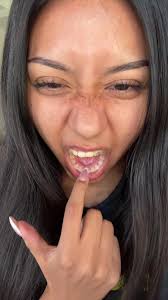 Braces Removal Before and After