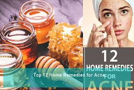 Top 12 Home Remedies For Acne