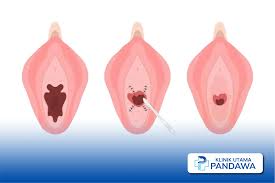 Pecah Perawan: Mitos vs Fakta Medis yang Perlu Anda Ketahui -