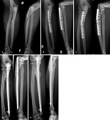 Intramedullare Nagelosteosynthese Der Ulna In Der Revisionschirurgie Springerlink