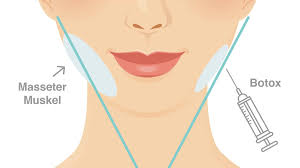 Masseter Botox Vorher Nachher: Echte Vorher-Nachher Bilder Und Ergebnisse –  Alles Zur Kieferverschmälerung Ohne OP - Readmagazine.de