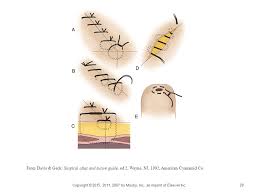 Chapter 7 Sutures Needles And Instruments Ppt Download